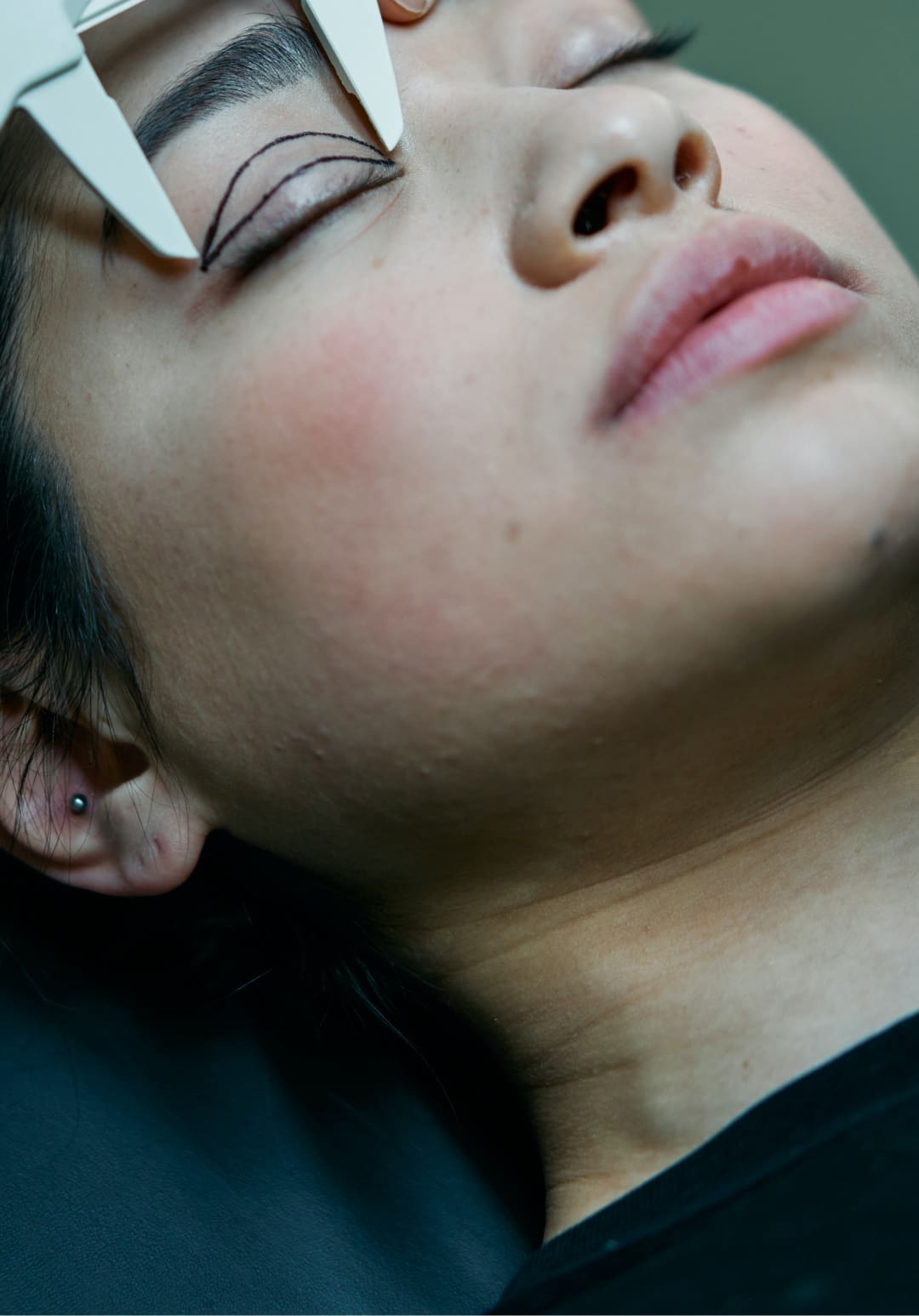 Patient with marked eyelid for surgery