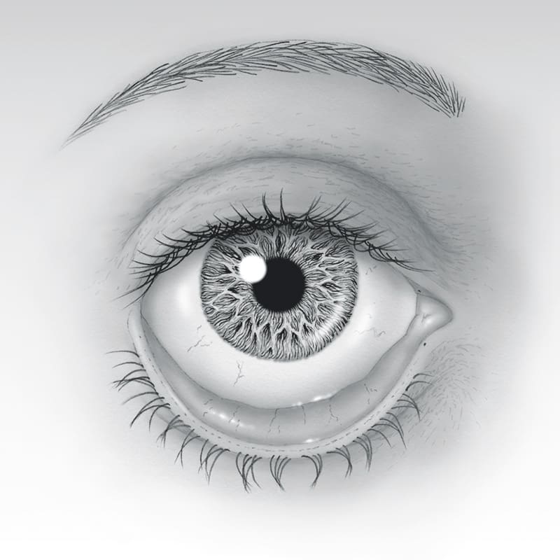 Turned-Out Eyelid (Ectropion)