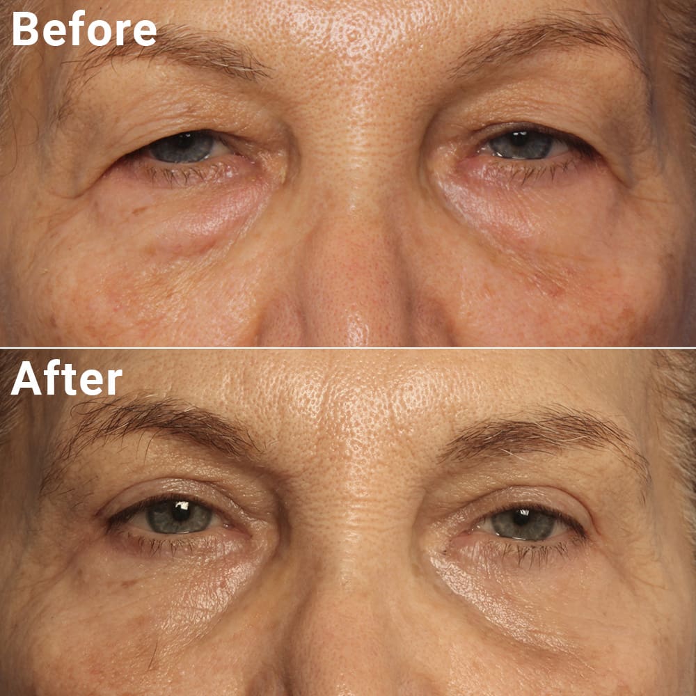 Comparative photos showing eye Blepharoplasty and Brow Lift