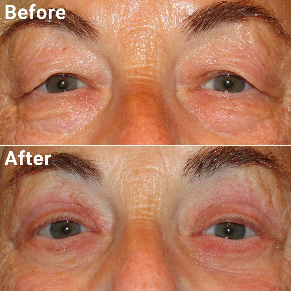 Comparative photos showing eye Blepharoplasty and Brow Lift