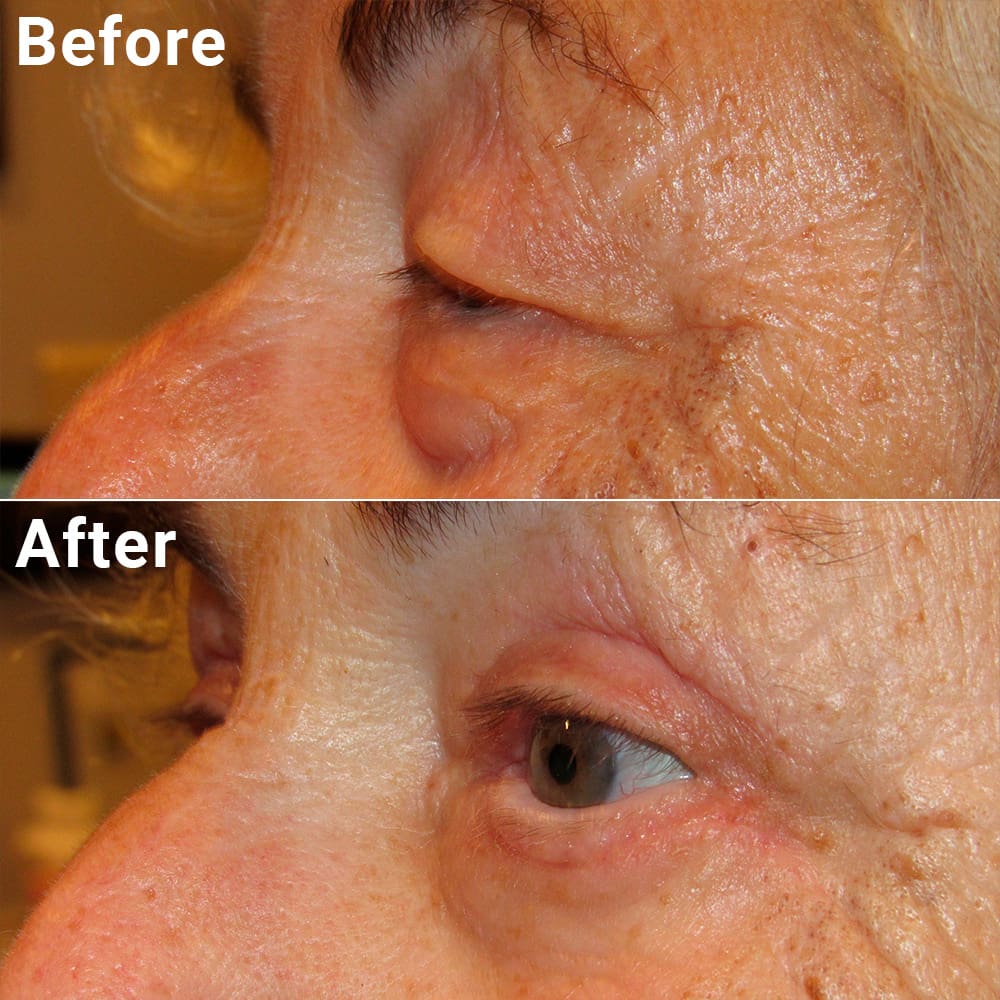 Comparative photos showing eye Blepharoplasty and Brow Lift