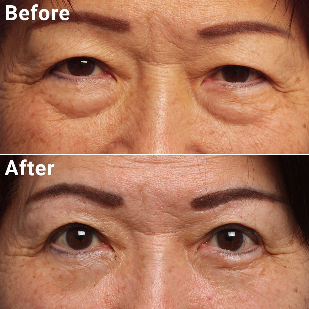 Comparative photos showing eye Blepharoplasty and Brow Lift