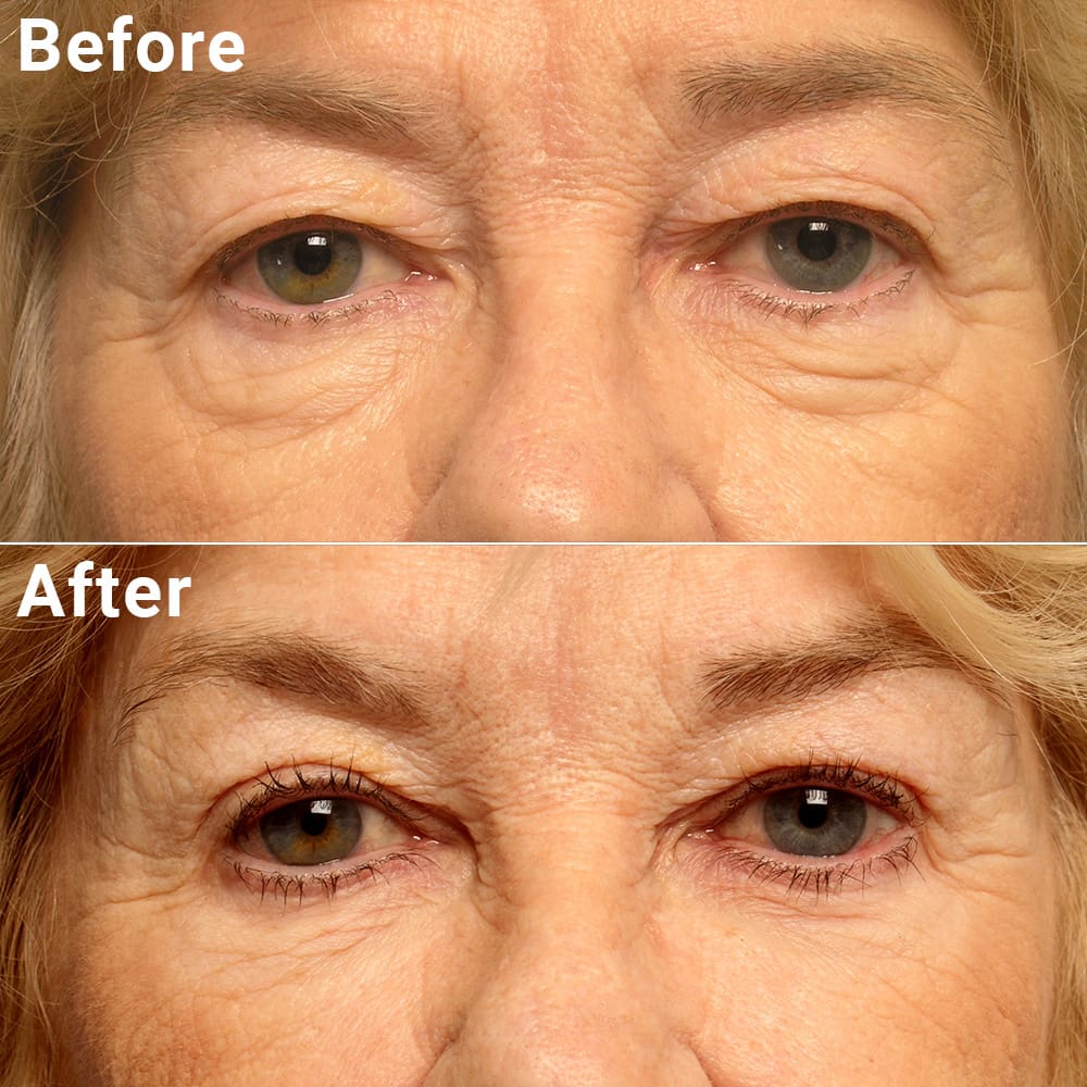 Comparative photos showing eye Blepharoplasty and Brow Lift