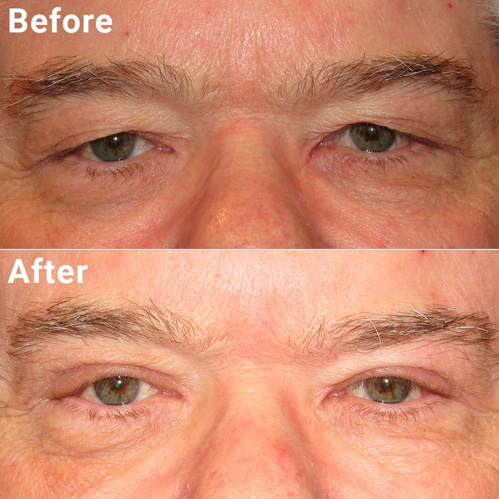 Comparative photos showing eye Blepharoplasty and Brow Lift