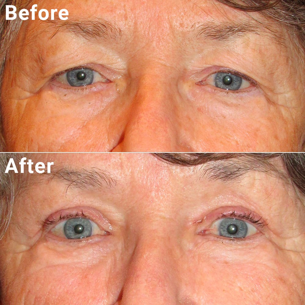 Comparative photos showing eye Blepharoplasty and Brow Lift