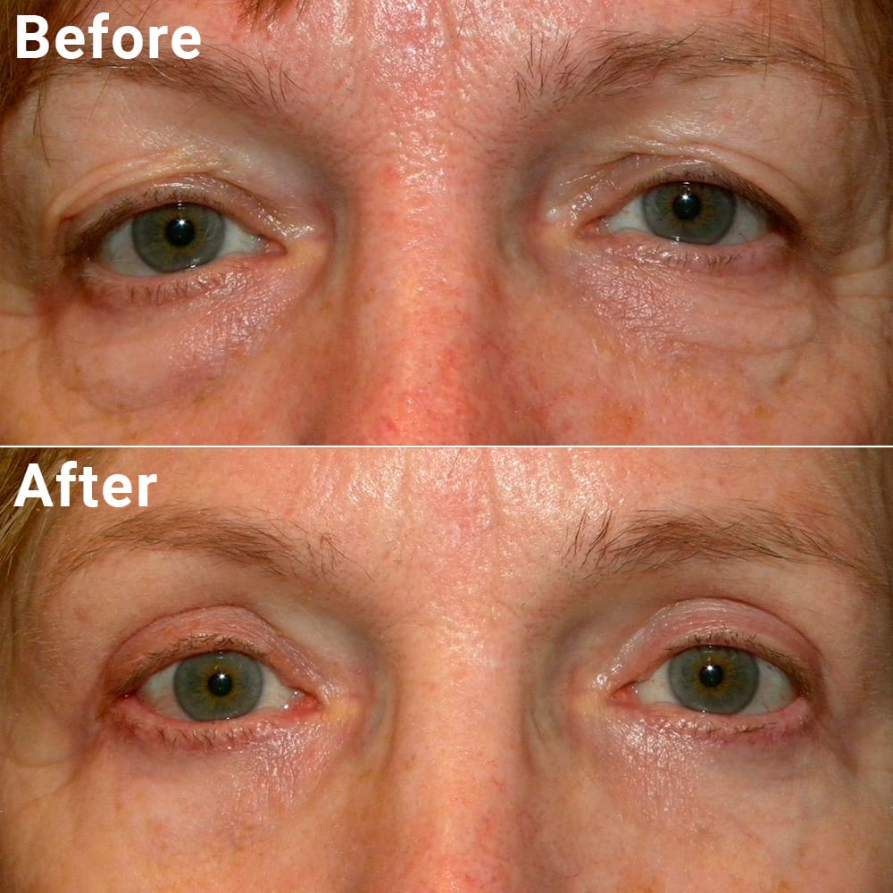 Comparative photos showing eye Blepharoplasty and Brow Lift