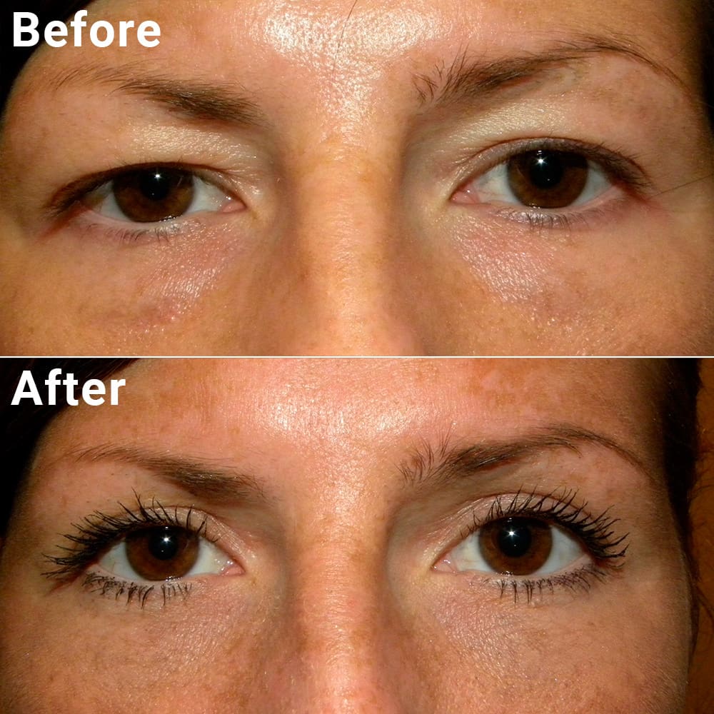 Comparative photos showing eye Blepharoplasty and Brow Lift