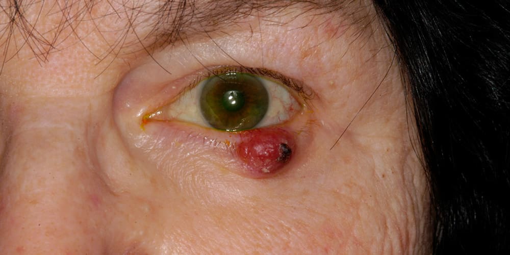 Photo showing eyelid skin cancer
