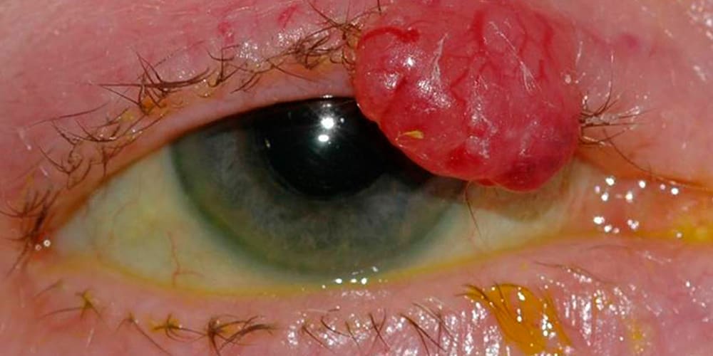 Photo showing eyelid skin cancer