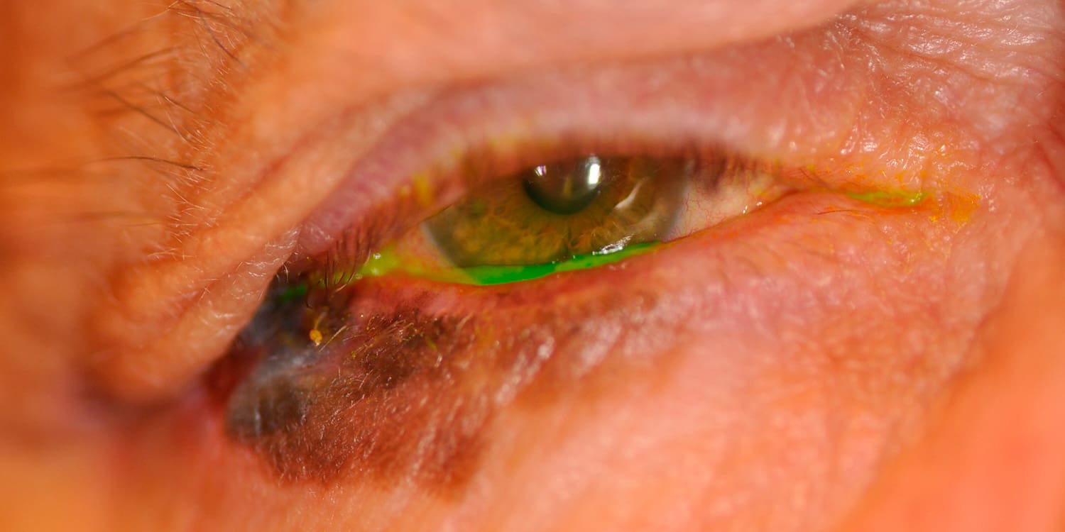 Photo showing eyelid skin cancer