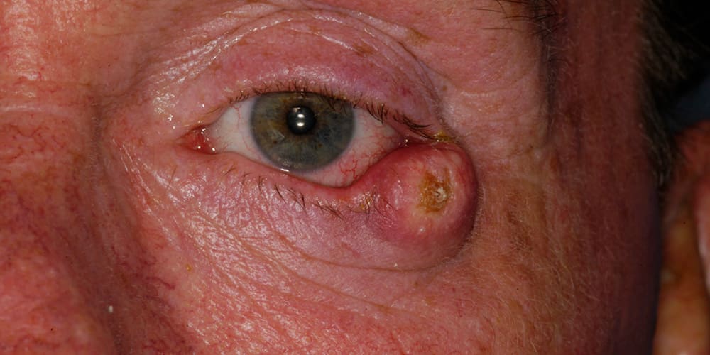 Photo showing eyelid skin cancer