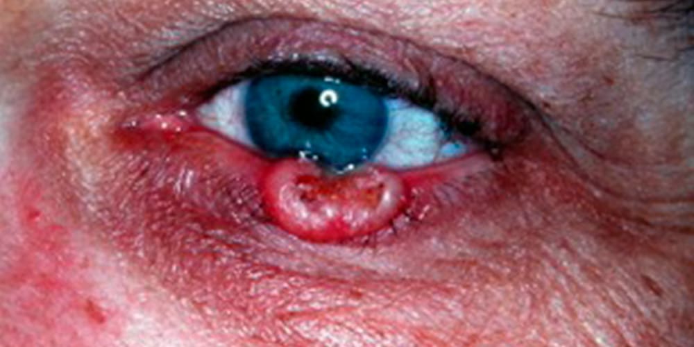 Photo showing eyelid skin cancer