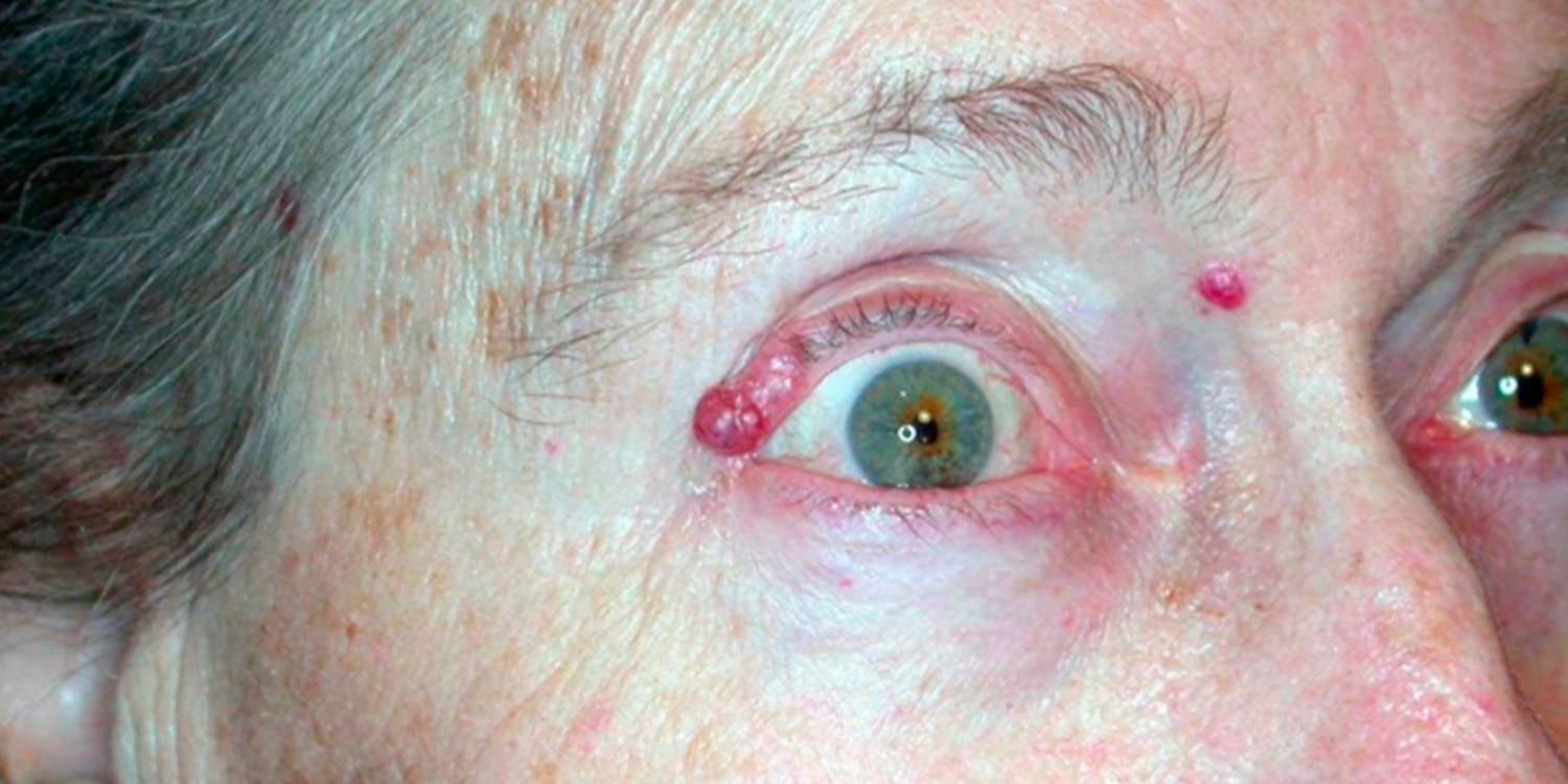 Photo showing eyelid skin cancer