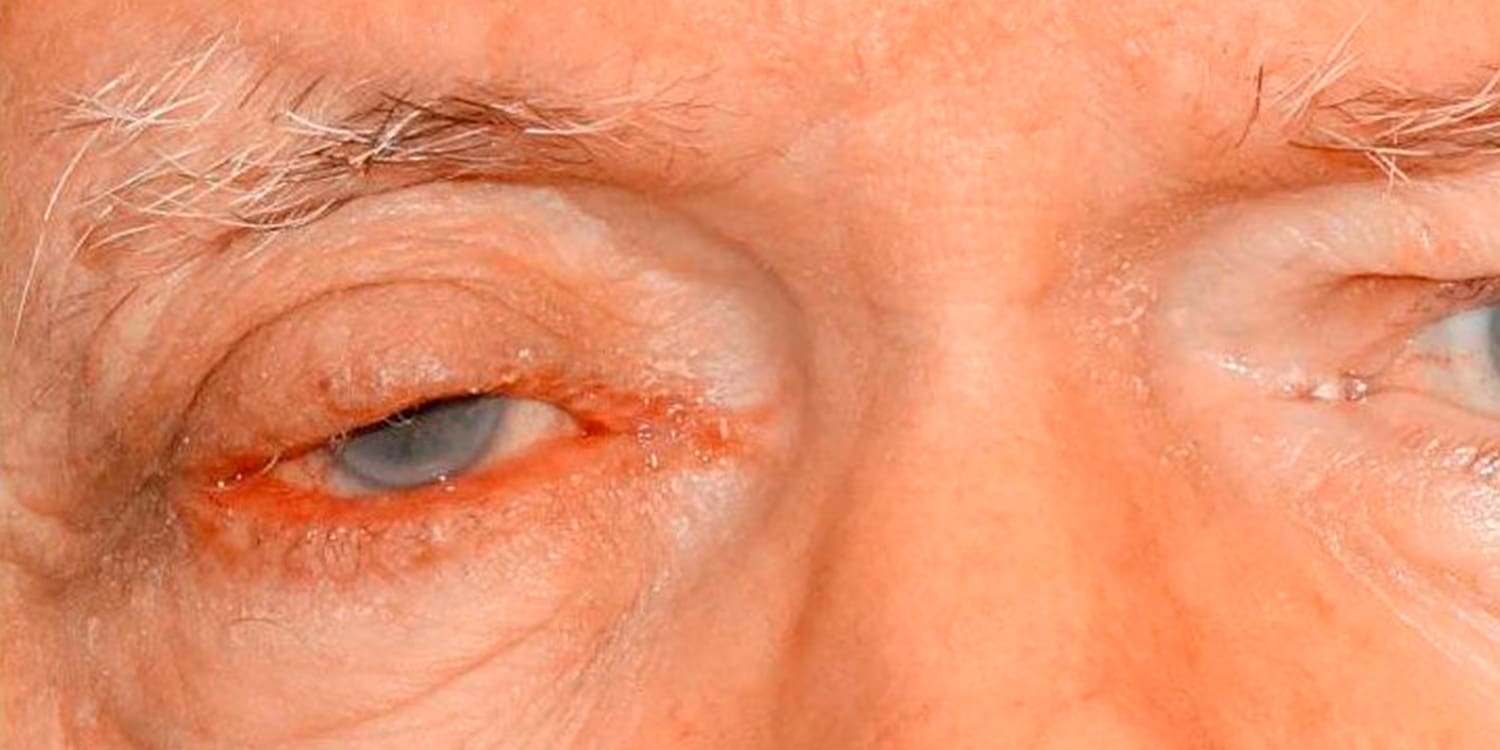 Photo showing eyelid skin cancer