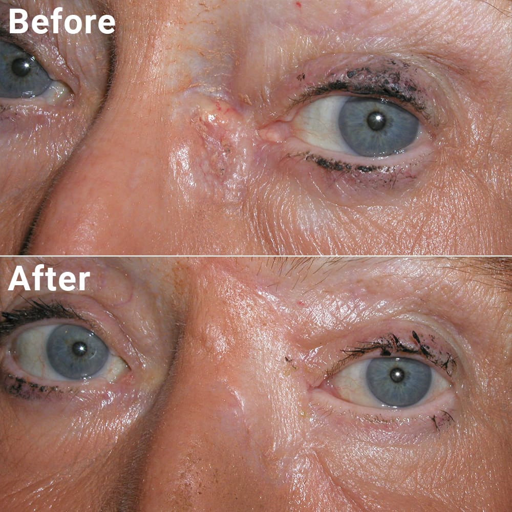 Comparative photos showing eyelid procedure results