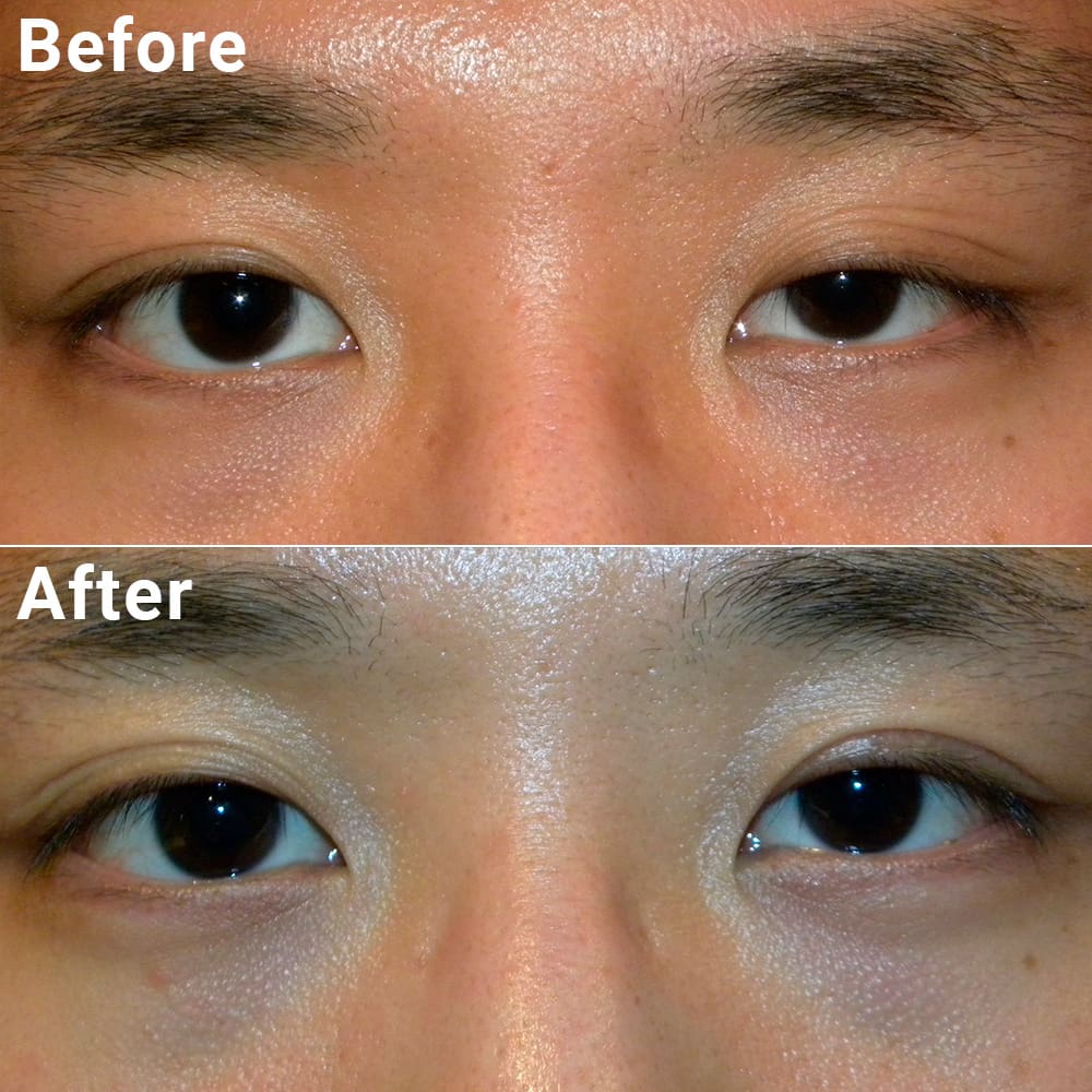 Comparative photos showing eyelid procedure results