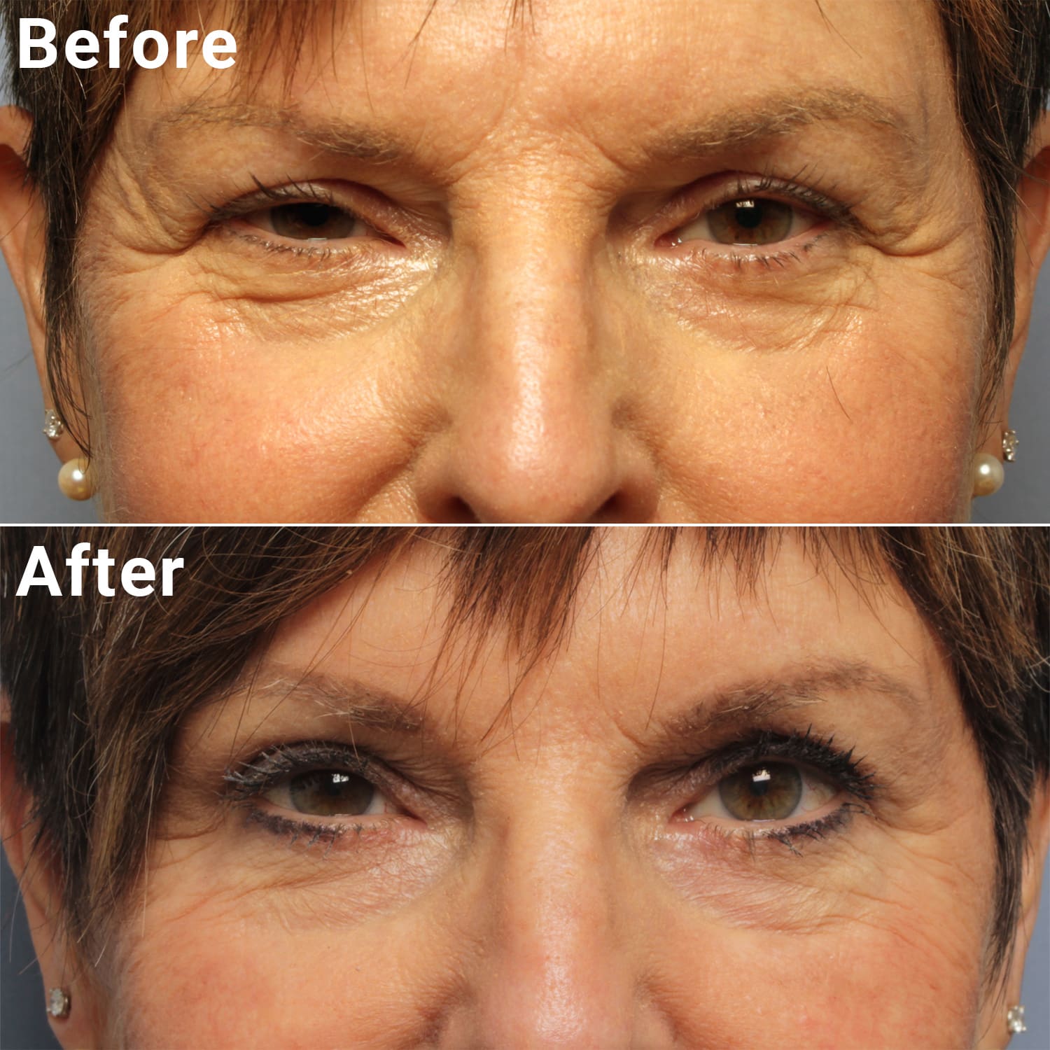 Comparative photos showing eyelid procedure results