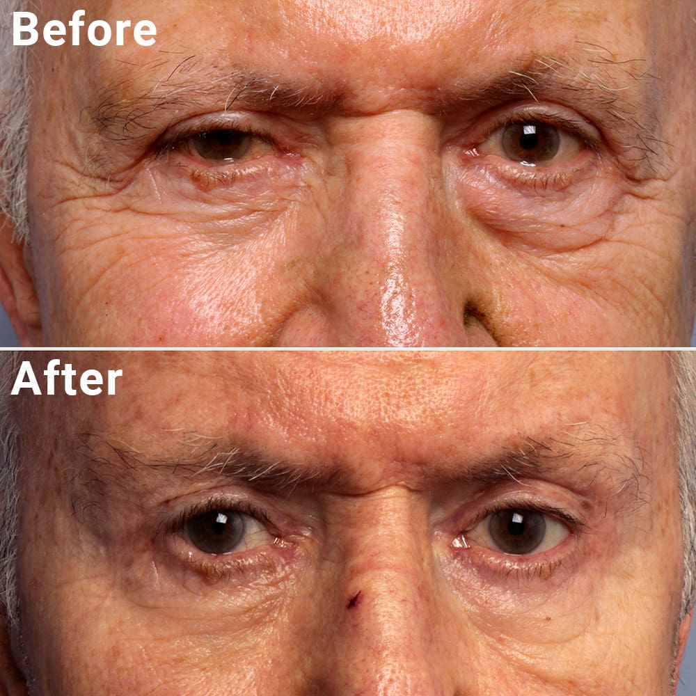 Comparative photos showing eyelid procedure results