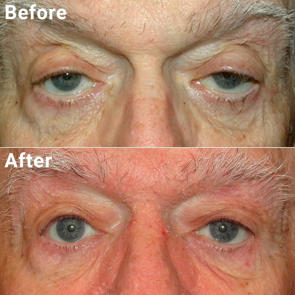 Comparative photos showing eyelid procedure results