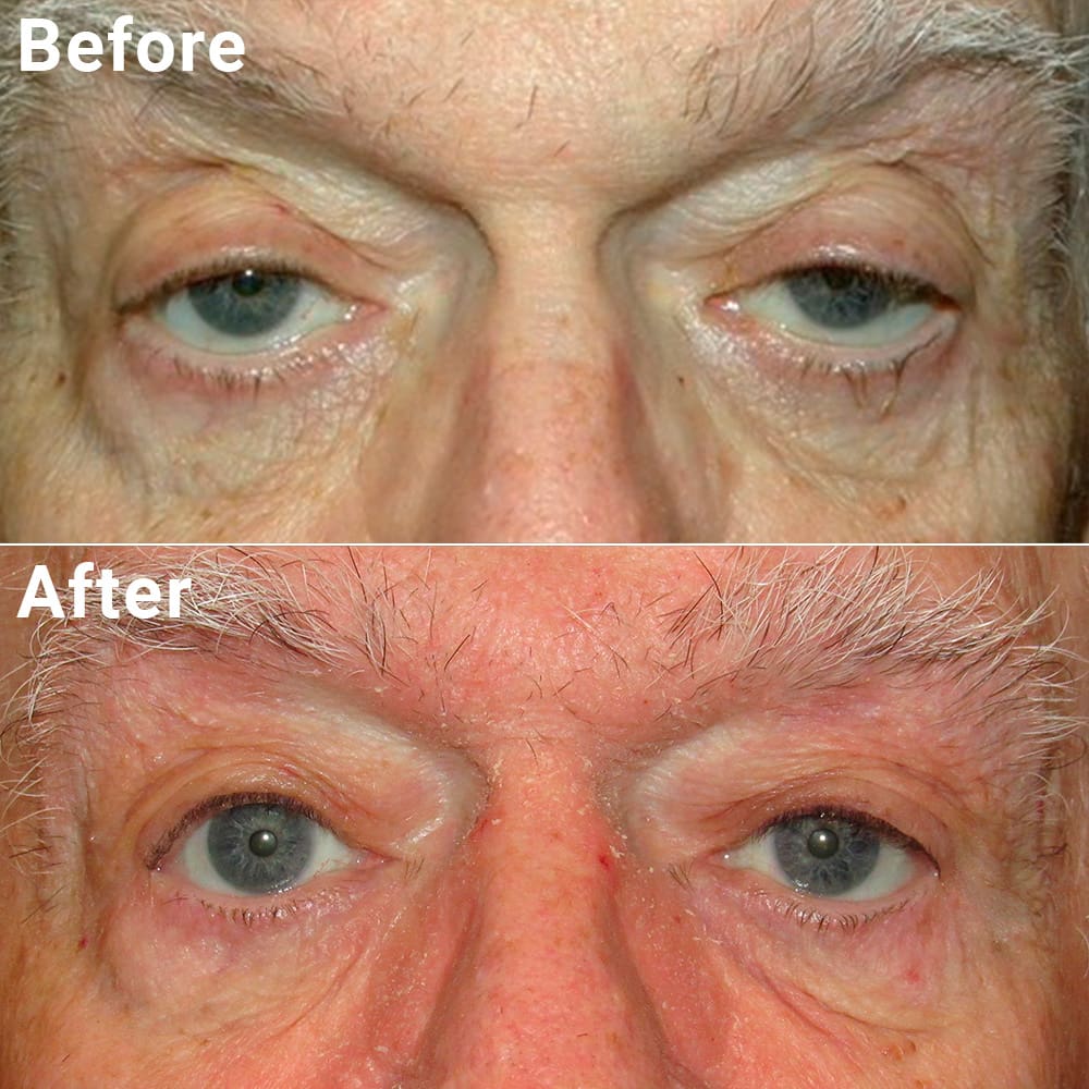 Comparative photos showing eyelid procedure results