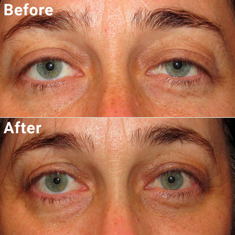 Comparative photos showing eyelid procedure results