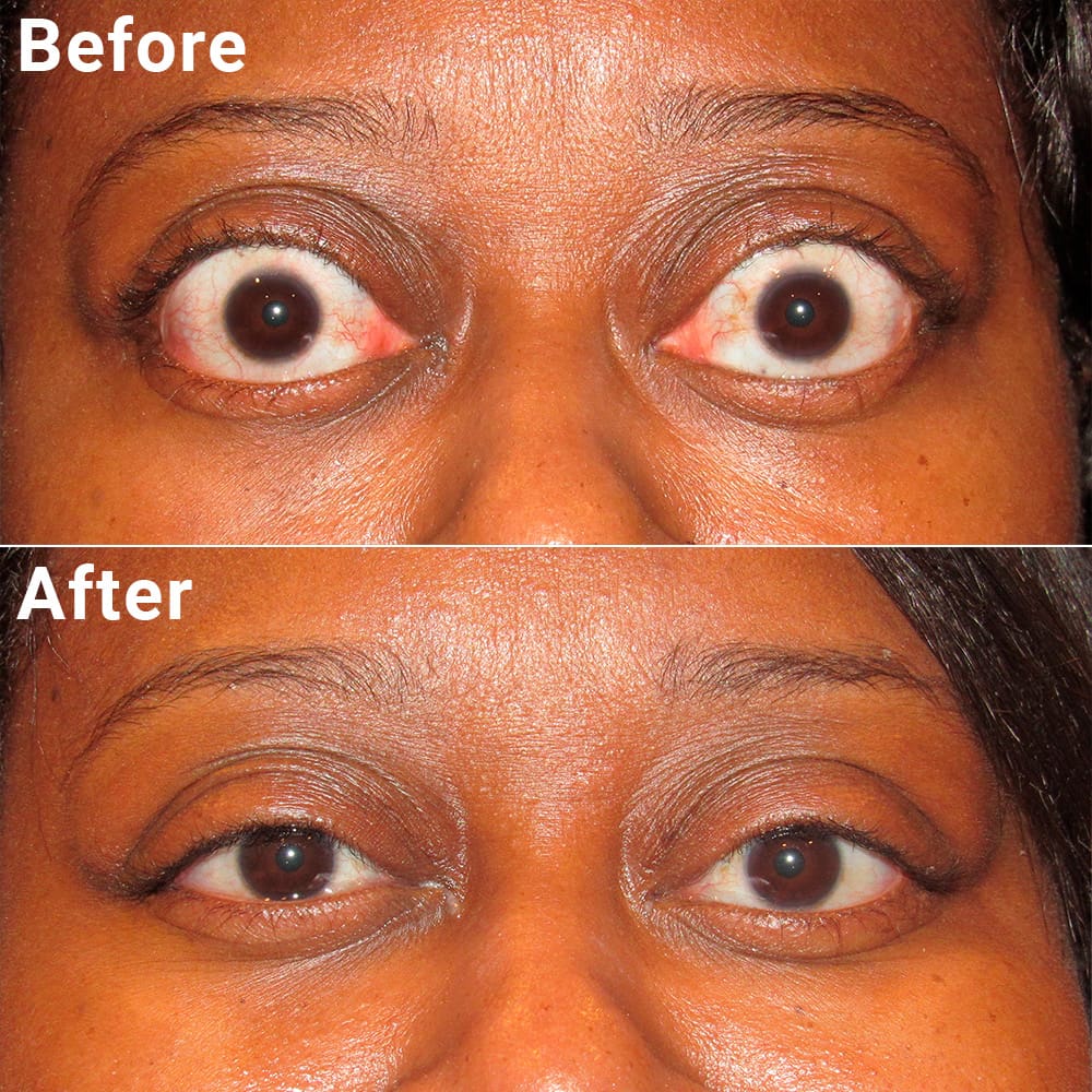 Before and after images of an eyelid surgery