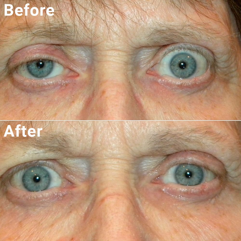 Before and after images of an eyelid surgery